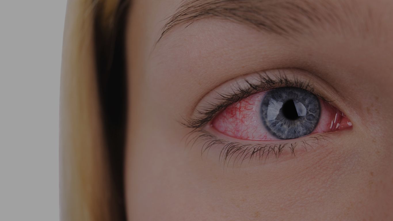 Can Dry Eye Syndrome Cause Red Eyes?